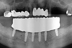 Digital-Workflow-for-Full-Arch-Implant-Supported-Teeth-Chrome-GuidedSmile-Kazemi-Oral-Surgery-Bethesda-Implant-Dentist.019