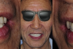 Digital-Workflow-for-Full-Arch-Implant-Supported-Teeth-Chrome-GuidedSmile-Kazemi-Oral-Surgery-Bethesda-Implant-Dentist.020