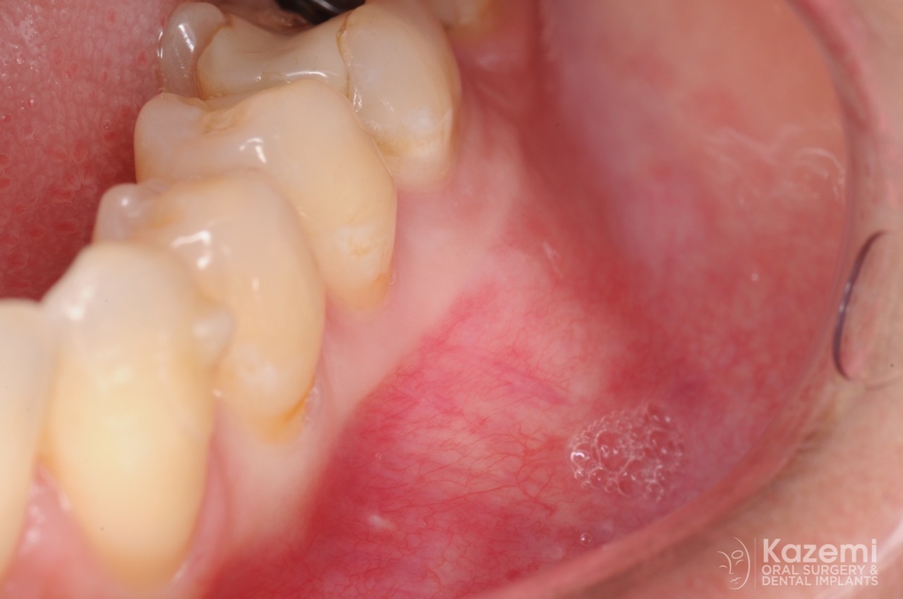focal cemento-osseous dysplasia kazemi oral surgery01