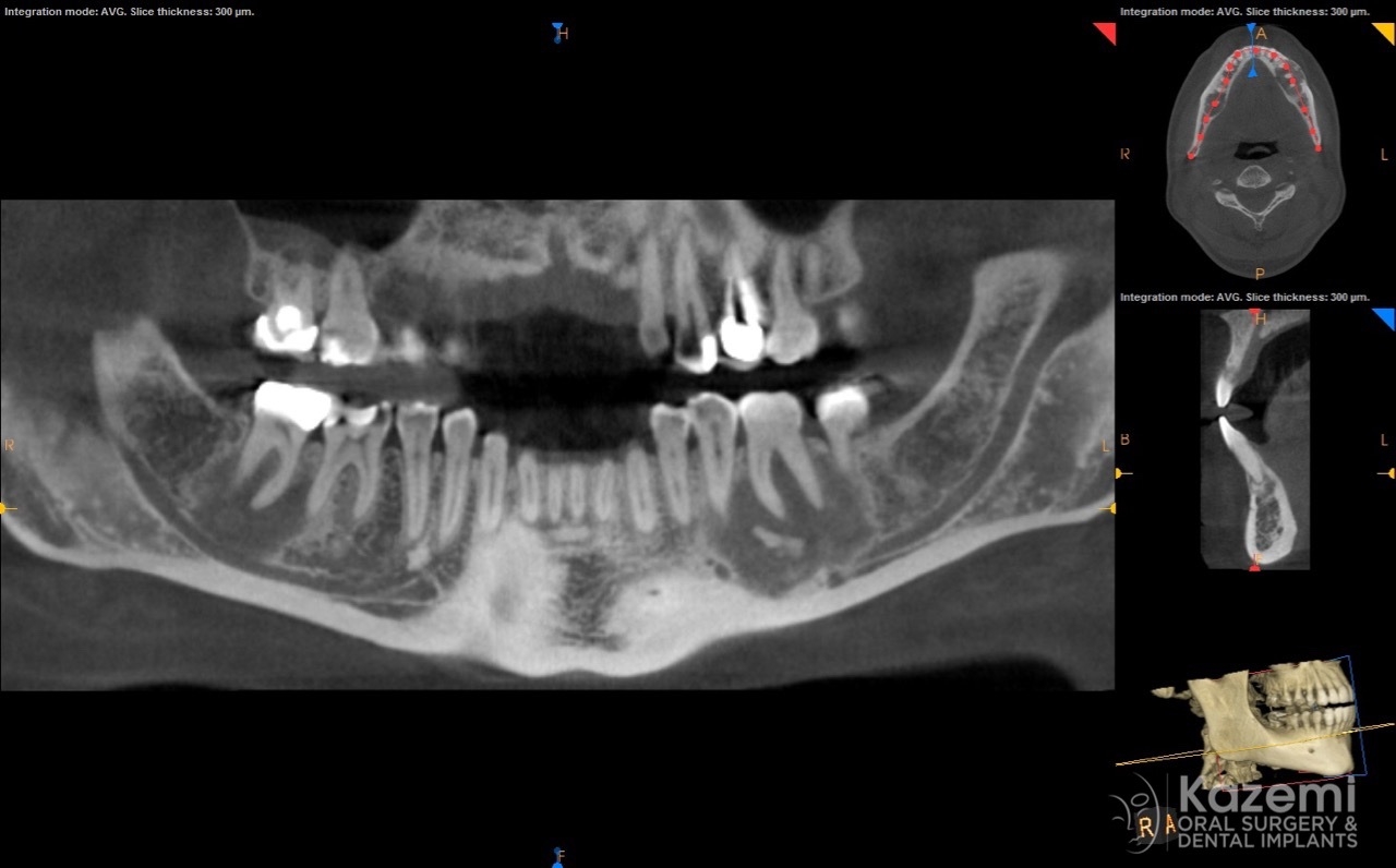 focal cemento-osseous dysplasia kazemi oral surgery04