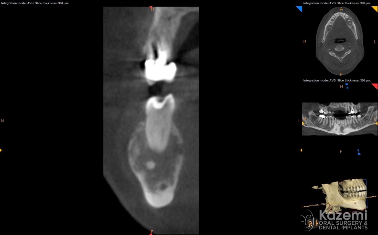 focal cemento-osseous dysplasia kazemi oral surgery07