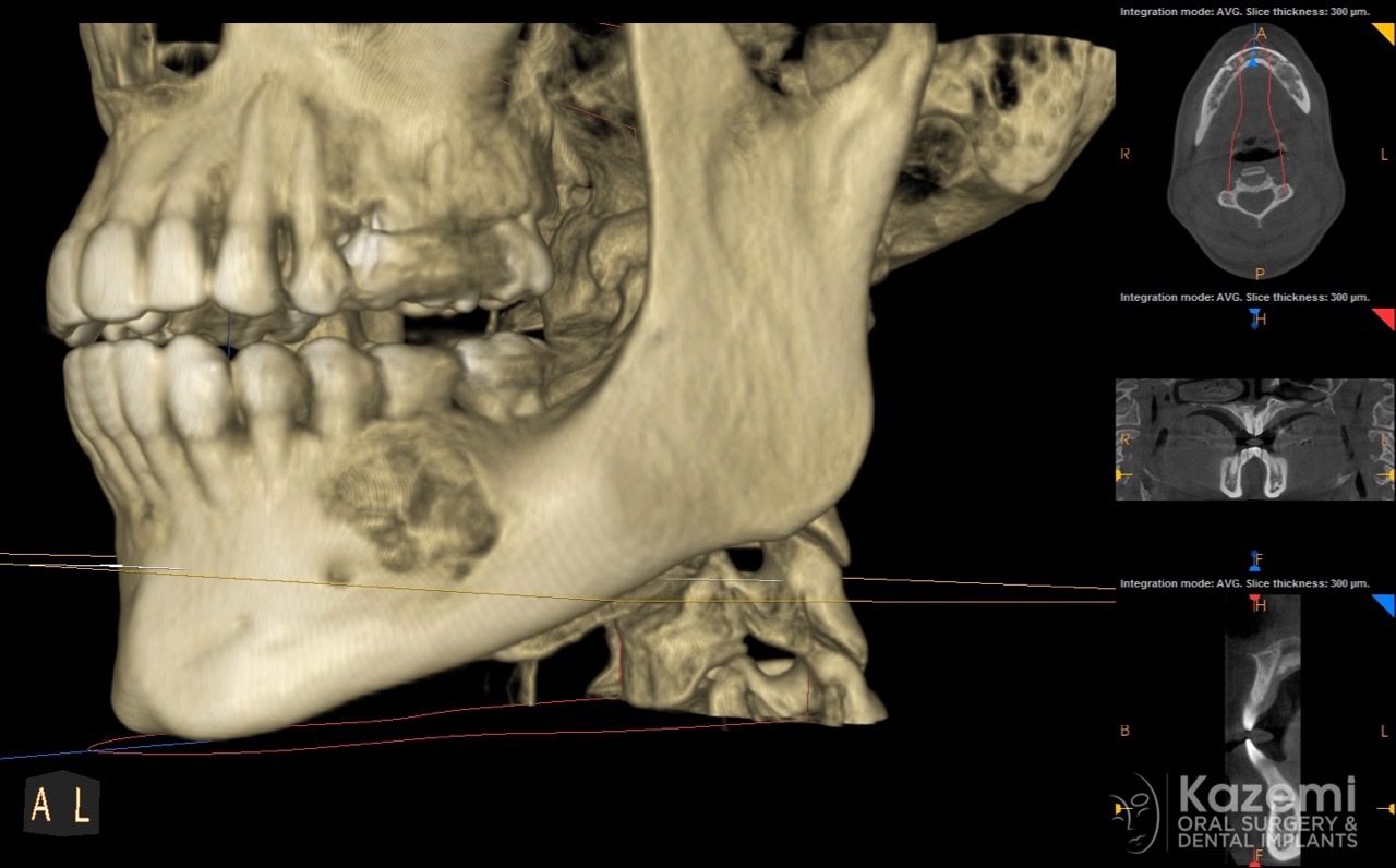 focal cemento-osseous dysplasia kazemi oral surgery02