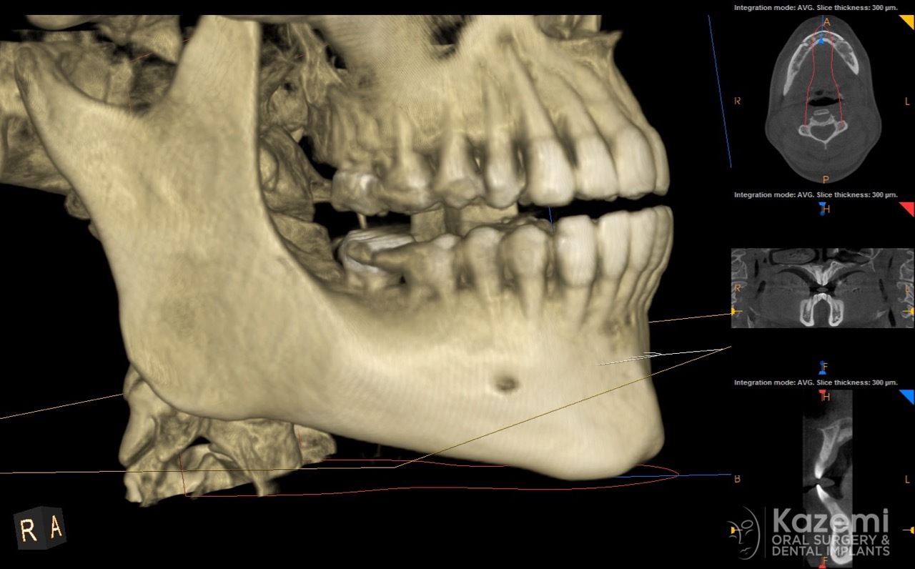focal cemento-osseous dysplasia kazemi oral surgery03