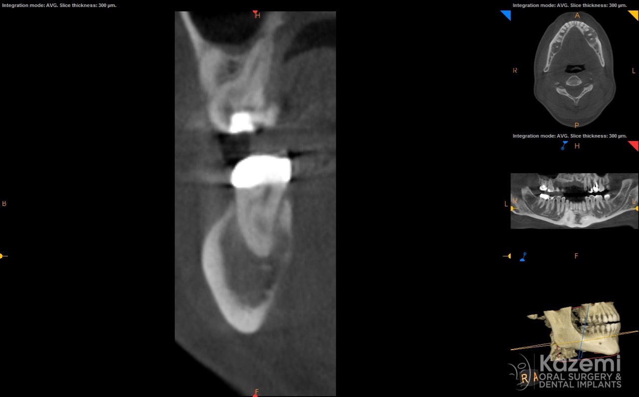 focal cemento-osseous dysplasia kazemi oral surgery06