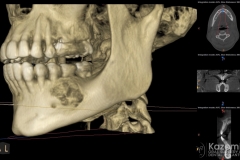 focal cemento-osseous dysplasia kazemi oral surgery02