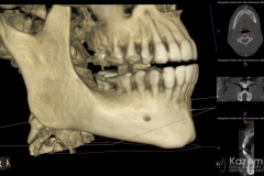 focal cemento-osseous dysplasia kazemi oral surgery03