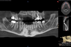 focal cemento-osseous dysplasia kazemi oral surgery04