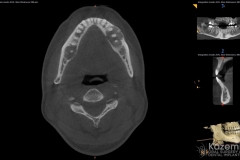 focal cemento-osseous dysplasia kazemi oral surgery05