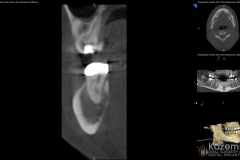 focal cemento-osseous dysplasia kazemi oral surgery06