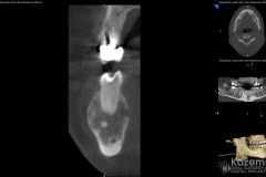 focal cemento-osseous dysplasia kazemi oral surgery07