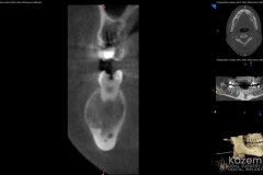 focal cemento-osseous dysplasia kazemi oral surgery08