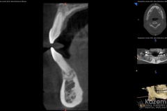 focal cemento-osseous dysplasia kazemi oral surgery09