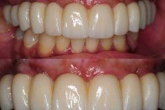 Chamberlain0 Pink-Free Full Arch - 4