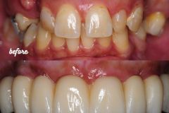 Chamberlain0 Pink-Free Full Arch - 5