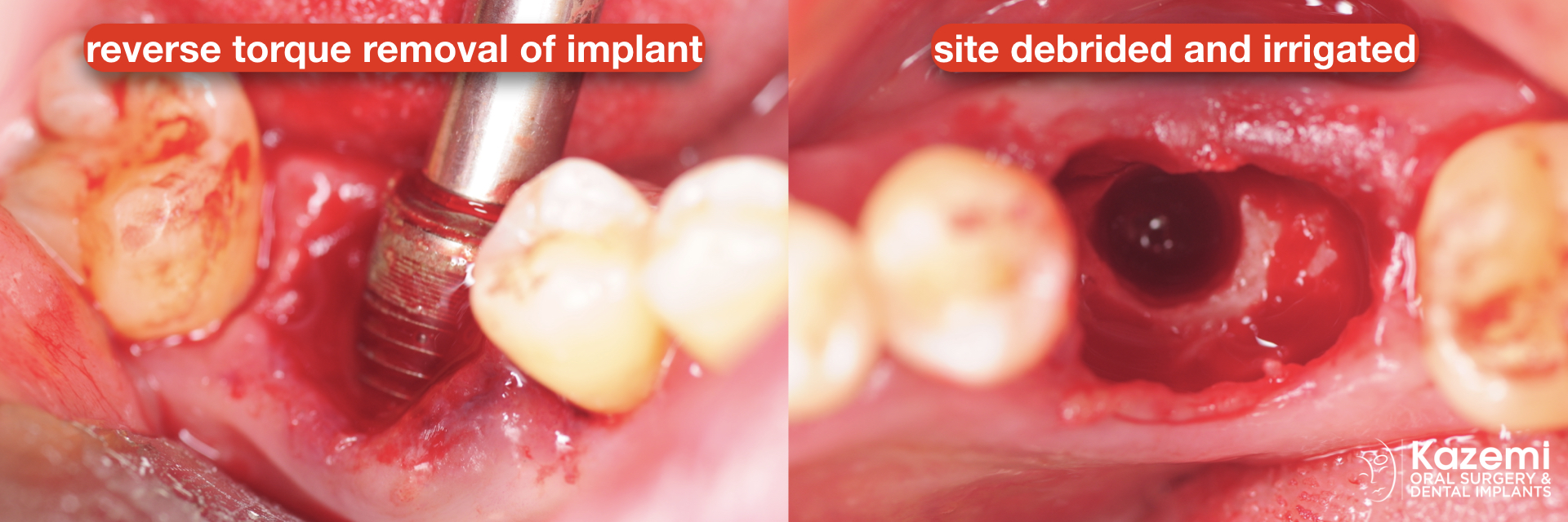 Peri-implantitis-secondary-to-residual-cement-and-plaque-calculus-biofilm-on-the-tissue-surface-of-the-restoration-kazemi-oral-surgery-4