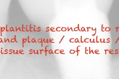 Peri-implantitis-secondary-to-residual-cement-and-plaque-calculus-biofilm-on-the-tissue-surface-of-the-restoration-kazemi-oral-surgery-1