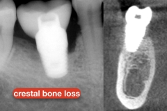 Peri-implantitis-secondary-to-residual-cement-and-plaque-calculus-biofilm-on-the-tissue-surface-of-the-restoration-kazemi-oral-surgery-2