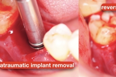 Peri-implantitis-secondary-to-residual-cement-and-plaque-calculus-biofilm-on-the-tissue-surface-of-the-restoration-kazemi-oral-surgery-3