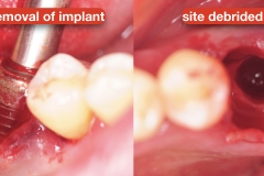 Peri-implantitis-secondary-to-residual-cement-and-plaque-calculus-biofilm-on-the-tissue-surface-of-the-restoration-kazemi-oral-surgery-4