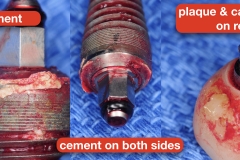 Peri-implantitis-secondary-to-residual-cement-and-plaque-calculus-biofilm-on-the-tissue-surface-of-the-restoration-kazemi-oral-surgery-5