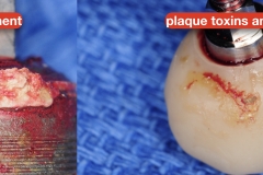Peri-implantitis-secondary-to-residual-cement-and-plaque-calculus-biofilm-on-the-tissue-surface-of-the-restoration-kazemi-oral-surgery-6