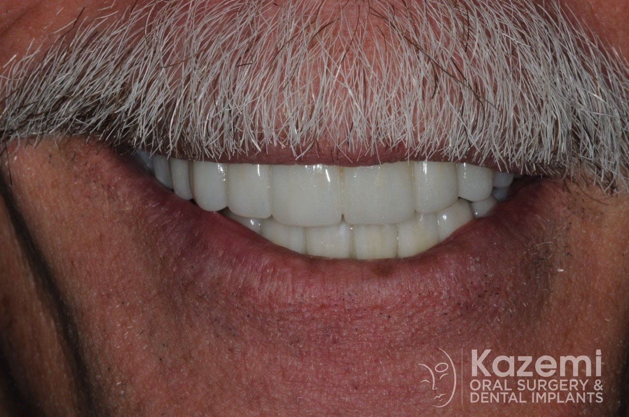 Complete dental implants crown and bridge kazemi oral surgery full arch0005