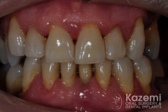 Complete dental implants crown and bridge kazemi oral surgery full arch0000