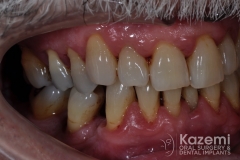 Complete dental implants crown and bridge kazemi oral surgery full arch0001