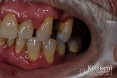 Complete dental implants crown and bridge kazemi oral surgery full arch0002