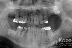 Complete dental implants crown and bridge kazemi oral surgery full arch0003