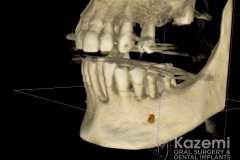 Complete dental implants crown and bridge kazemi oral surgery full arch0004