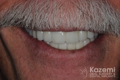 Complete dental implants crown and bridge kazemi oral surgery full arch0005