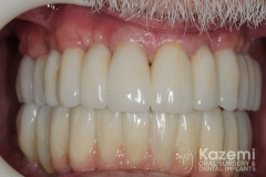 Complete dental implants crown and bridge kazemi oral surgery full arch0006