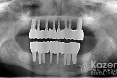 Complete dental implants crown and bridge kazemi oral surgery full arch0007