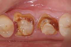 1. extraction of teeth oral surgeon best dentist bethesda
