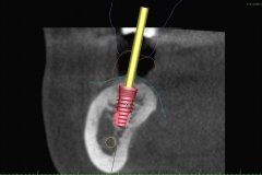10. computer assisted implant planning oral surgeon best dentist bethesda
