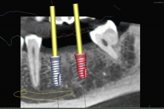 11. digital planning for dental implants oral surgeon best dentist bethesda