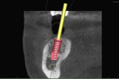12. safe placement of dental implant oral surgeon best dentist bethesda