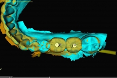 14. implant crown design digital oral surgeon best dentist bethesda