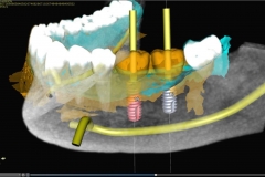 15. digital implant dentist oral surgeon best dentist bethesda