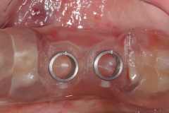 16. cad cam implant surgical guide oral surgeon best dentist bethesda