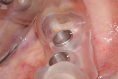 17. 3d printing of dental implant surgical guide oral surgeon best dentist bethesda