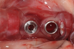 18. dental implant surgical guide oral surgeon best dentist bethesda