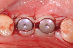 19 dental implants lower molars with healing abutment oral surgeon best dentist bethesda