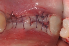 2. healing of extraction oral surgeon best dentist bethesda