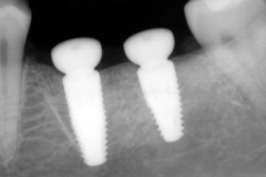 20. dental implants xray oral surgeon best dentist bethesda