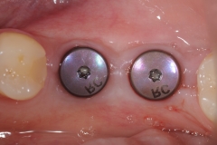 21. dental implants integrated oral surgeon best dentist bethesda