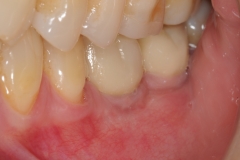 22. implant teeth oral surgeon best dentist bethesda