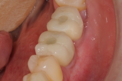 23. dental implant crowns oral surgeon best dentist bethesda