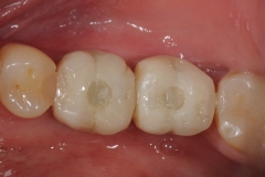 24. screw retained dental implants oral surgeon best dentist bethesda